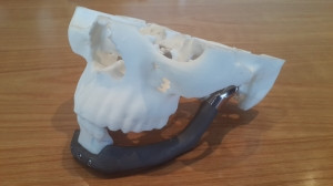 A locally-printed jaw that was transplanted into a patient whose face was disfigured.