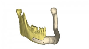 A 3D model of a titanium jaw implant that was printed in SA.